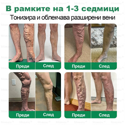 🇧🇬👨‍⚕️✅✅Moauou® Микроиглен пластир за таргетирано действие при разширени вени ⚡Незабавно облекчение, дълготраен ефект — специална промоция